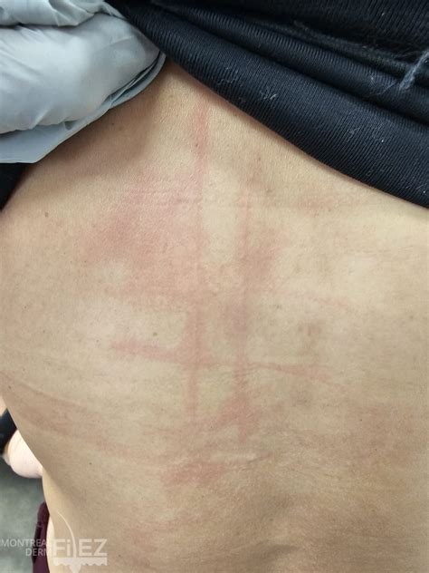 Urticaria and Angioedema Gallery – Montreal Derm FilEZ