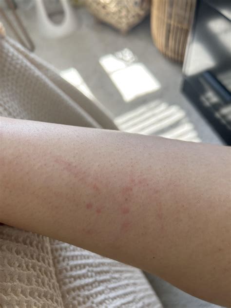 Bug bites or allergic reaction? : r/AskDoctorSmeeee