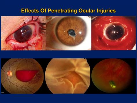 Penetrating Eye Injuries - Introduction, types and Management | PPT
