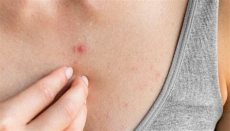 Espinhas Pelo Corpo Dst - O que causa espinhas em cada lugar do corpo: indica doenças? - Tá Saudável