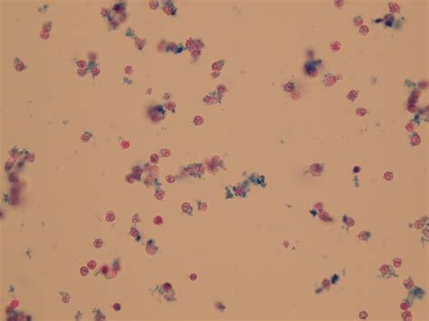 Leukocytes in Urine