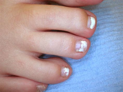 types  toenail fungus