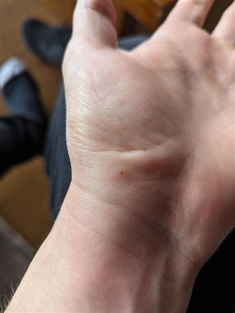 Bug bite identification : r/whatisthisbug