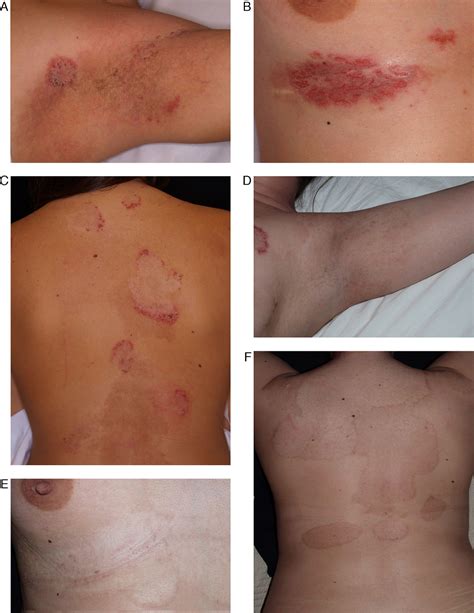 What Is The Treatment For Hailey Hailey Disease at Jaime Arndt blog