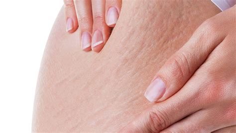 selulit penyebab gejala pengobatan klikdokter