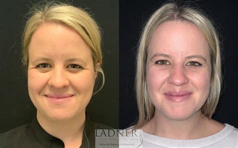 brow lift forehead lift    photo gallery denver
