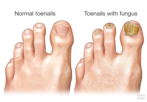 4 Classic Types of Nail Fungus - Toenail Fungus Treatment Center