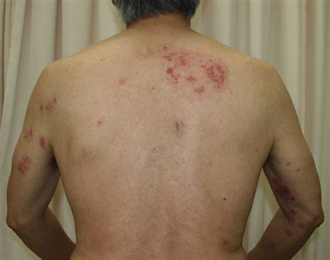 photo de stock de herpes zoster viral disease infecti vrogueco