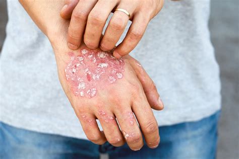 The Basics: Eczema