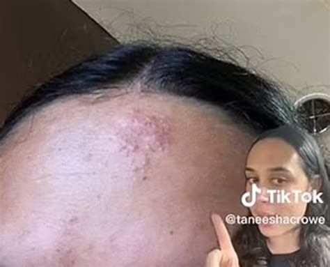 I got herpes on my face at a concert — and ended up in a hospital | New