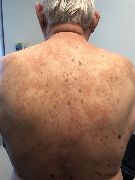 Recurring Rash - Dermatology Advisor