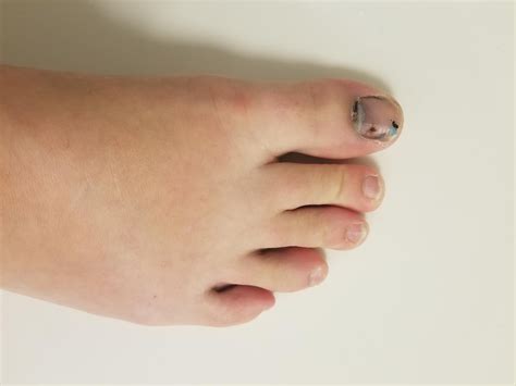 Open Fracture of Big Toe : r/brokenbones