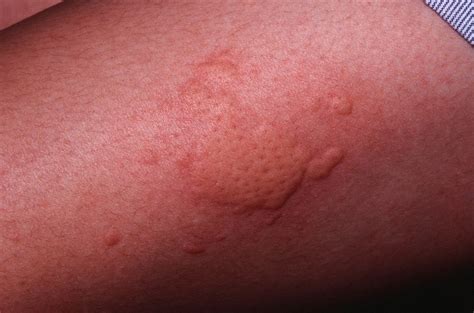 What Is Hives And What Does It Look Like – APYTX