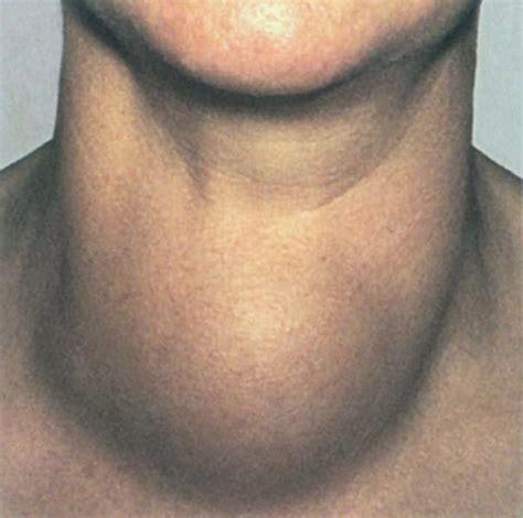 BIOLOGIJA 8/16. Hormonska regulacija/Gusavost