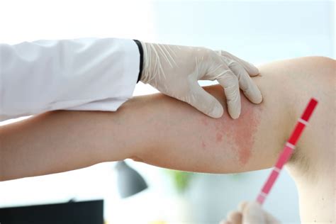 Manchas Na Pele Aids - Lesoes De Hiv No Rosto Problemas De Pele E Cabelos Na Pessoa Que Vive