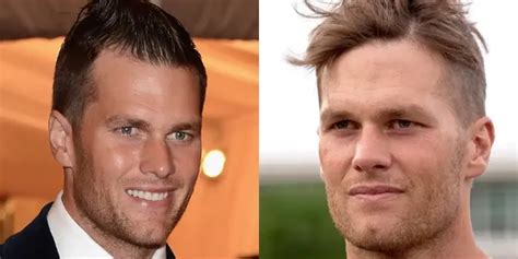 Tom Brady's Hair Transplant: Facts and Details - Hair System