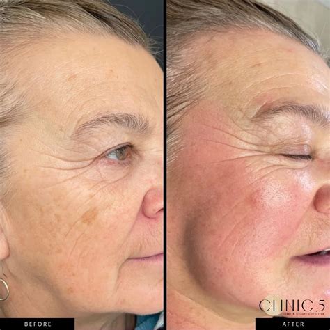 read   ipl laser hair removal comox valley medical spa