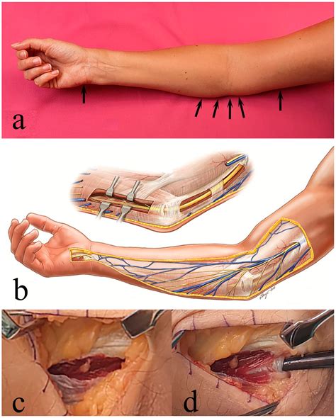 Ulnar Nerve Entrapment Collarbone