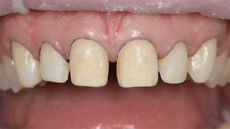 Porcelain Veneer Preparation Techniques Webinar