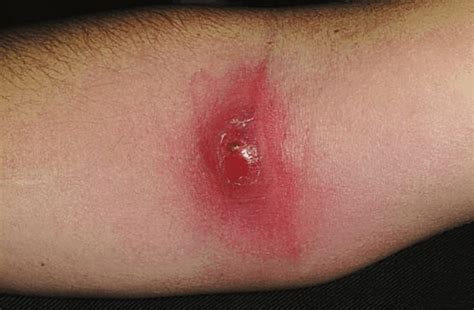 furuncle  rapidly evolved   plaque  atopic dermatitis