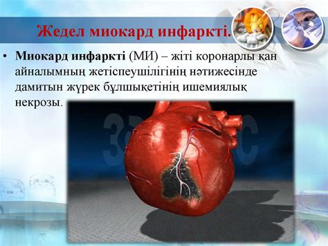 Миокард инфаркт ауруын дифференциалды диагнозы және диагностикасын ...