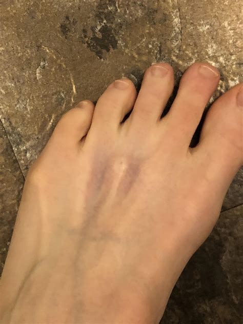 Cortisone Injection In My Foot at Meagan Brown blog