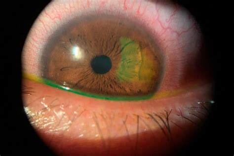 understanding corneal abrasions
