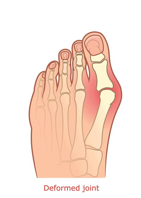 Bunion on the Heel | How to Prevent Bunions