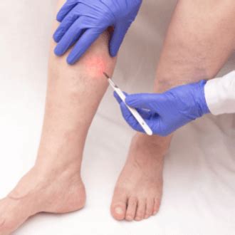 Trophic ulcers: causes, treatment and prevention