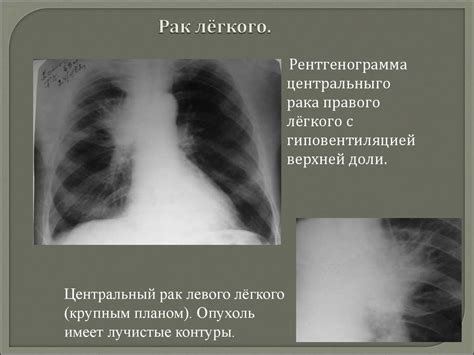 Рентгенологическая диагностика патологии лёгких - презентация онлайн