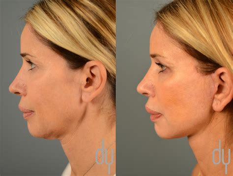 Facelift Before and After | Deep Plane Facelift Recovery | Beverly ...