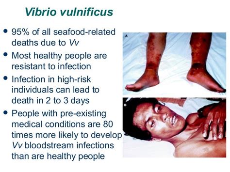 Vibrio vulnificus