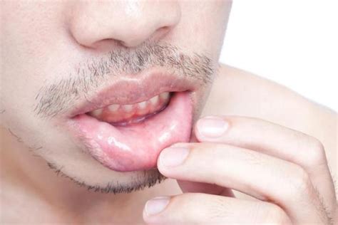 Formigamento Na Boca O Que Pode Ser - Formigamento nos lábios: o que pode ser e como tratar