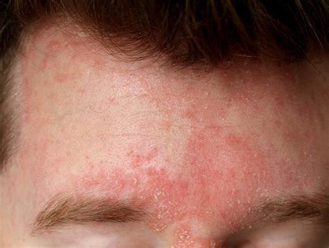 seborrheic dermatitis