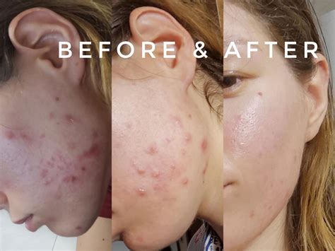 [Routine Help] I managed to clear my skin mostly, but still have some