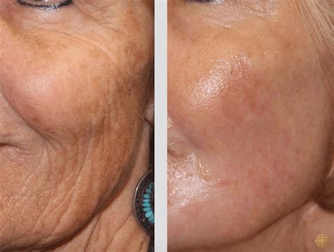 fractional  laser skin resurfacing    pictures case