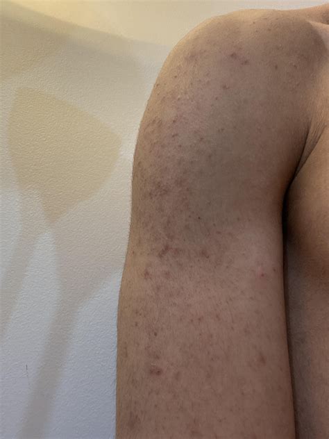 Is this KP? : r/keratosis