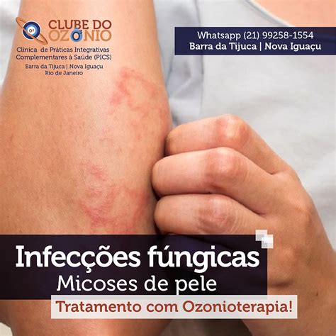 Infeccao De Pele Por Fungo