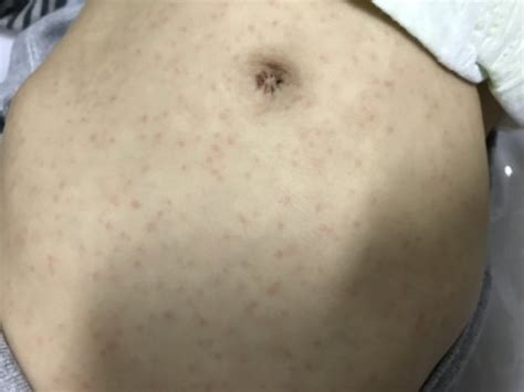 Bolinhas Vermelhas No Corpo Criança - Pintinhas vermelhas na pele! | BabyCenter