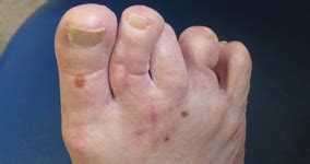 diseases   foot treatments   walk  foot clinic  central