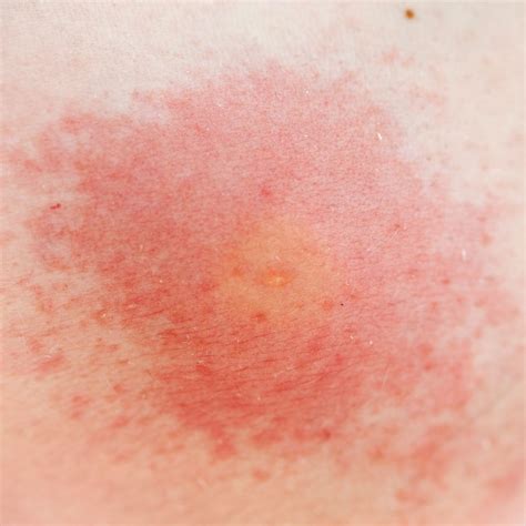 identifying insect bites  pictures  common bug bites