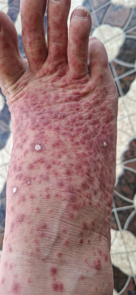 Strep Throat Rash On Hands Scarlet Fever In Children And Teenagers