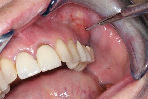 Haas-Fig-11-abscess-2 - Oral Health Group