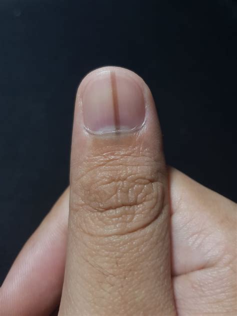 Dark Line on Fingernail : r/Melanoma