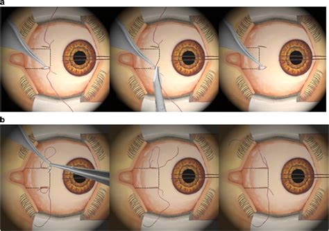 review minimally invasive strabismus surgery pmc