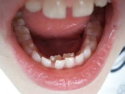Two rows of teeth – ParkAveSmile, Perfect Dental Clinic