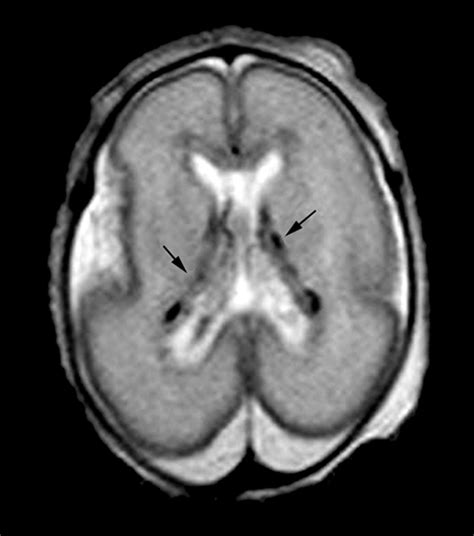 Magnetic resonance imaging of preterm brain injury | ADC Fetal