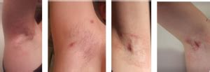 hidradenitis suppurativa pictures visualizing  hs