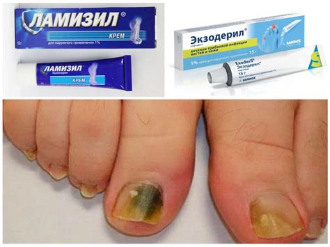 Недорогие, но эффективные противогрибковые мази