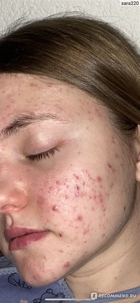 Крем ARAVIA Корректор азелаиновый Azelaic Correcting Cream ...